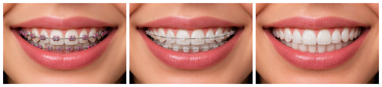 Aparelho Ortodôntico (dental) - DentVidaMed - Curitiba