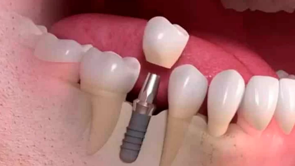 Exemplo de um Implante Dentário - DentVidaMed - Curitiba